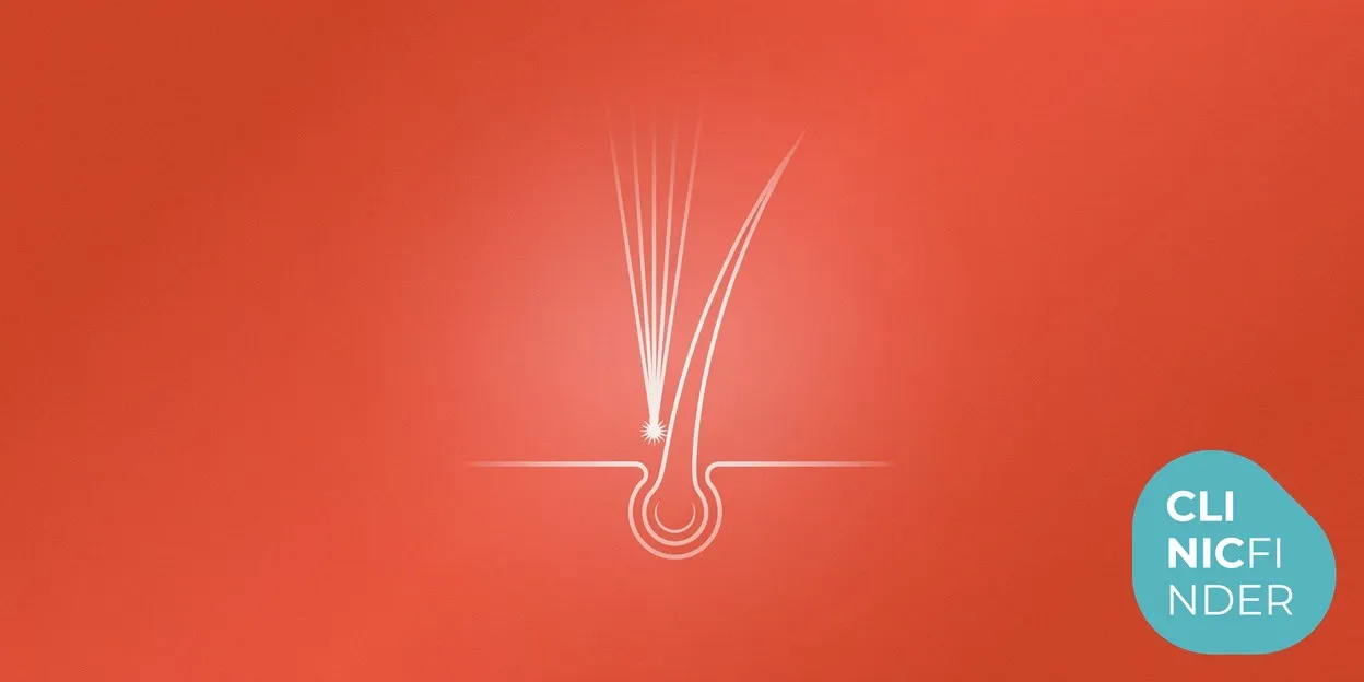 White line-art illustration of a focused beam of light converging on a single hair follicle, symbolising laser hair removal, on a deep coral background