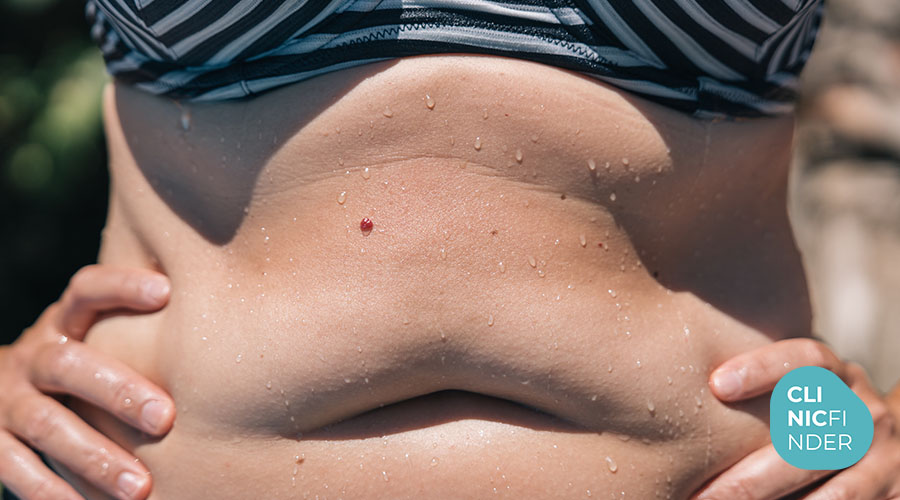 Person pinching a fold of subcutaneous fat at the waist